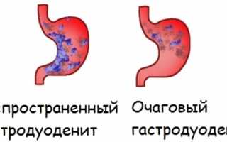 Что такое гастродуоденит