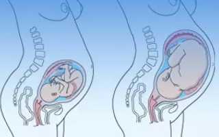 Тошнота в третьем триместре беременности