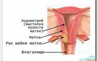 Можно ли увидеть рак шейки матки на УЗИ