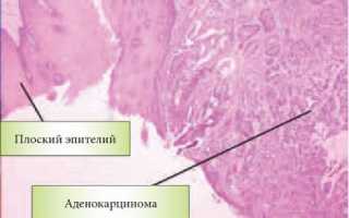 Плоскоклеточный рак пищевода