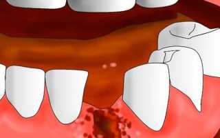 Стоматит после удаления зуба