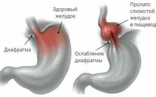 Пролапс слизистой желудка в пищевод